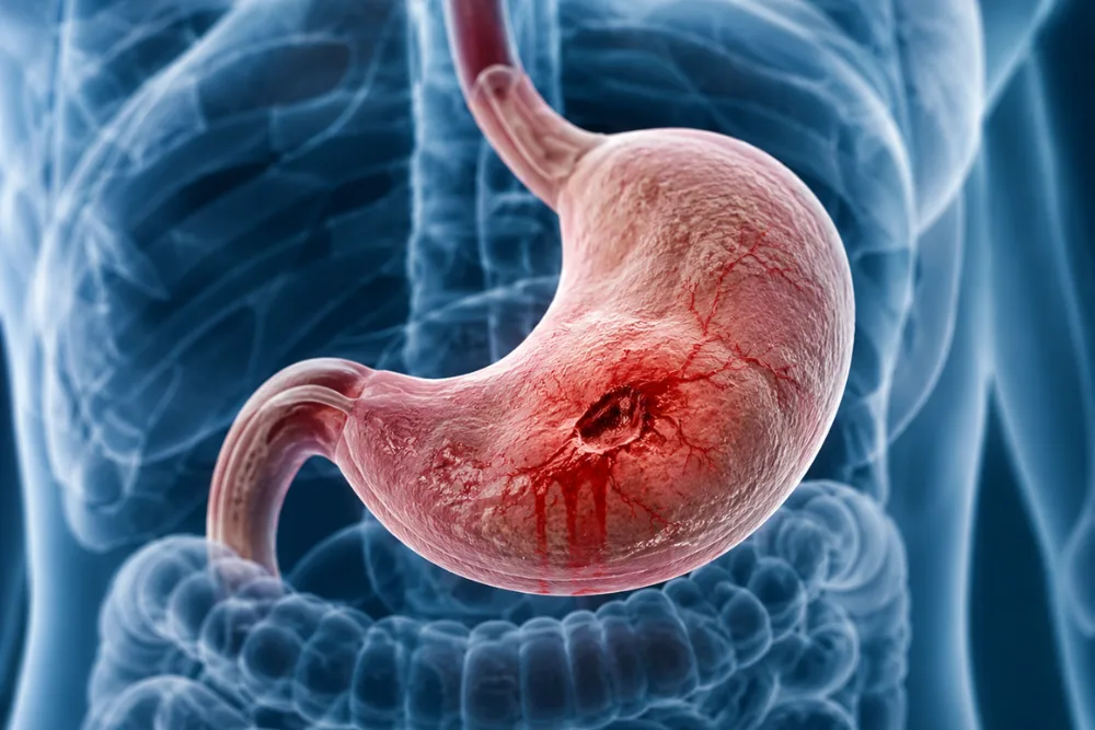 Tratamiento sangrado de tubo digestivo / úlcera gástrica en CDMX